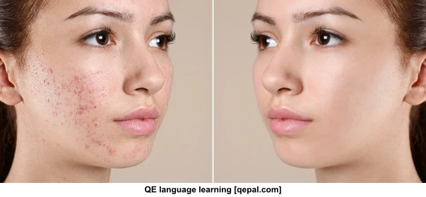 تصویر فلش کارت acne
