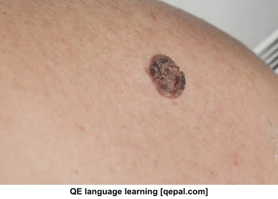 تصویر فلش کارت carcinoma