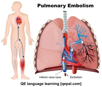تصویر فلش کارت embolism