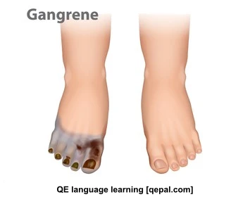 تصویر فلش کارت gangrene