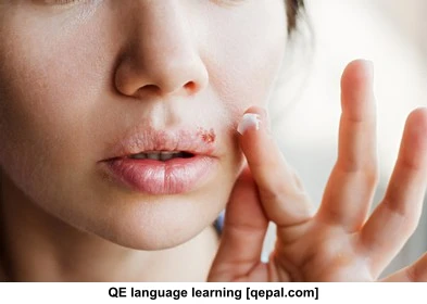 تصویر فلش کارت herpes