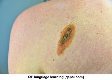 تصویر فلش کارت lesion