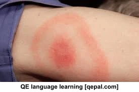 تصویر فلش کارت lyme disease