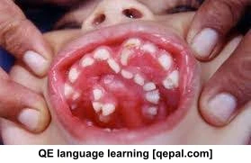تصویر فلش کارت supernumerary